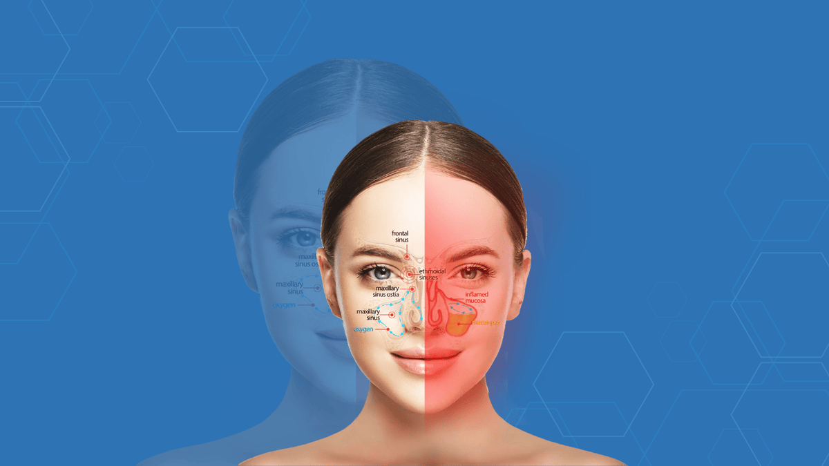 Sinusitis